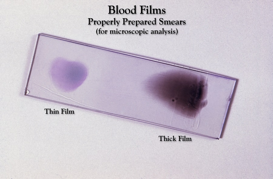 A microscope slide with a spot of blood on it.