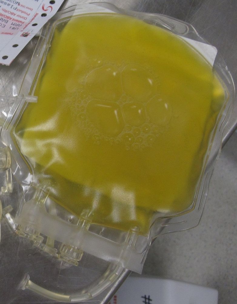 A clear plastic bag with frozen yellowish liquid inside