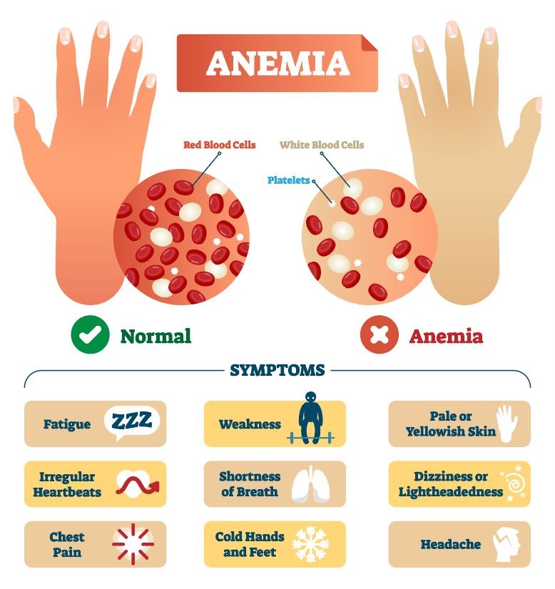 Medical labeled scheme with problematic red and white blood cells, and platelets. Microscopic diagram with disease diagnostic symptoms.