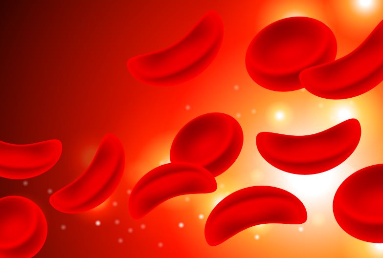 Normal, disc shaped red blood cells beside sickle cell anemia affected cells which are crescent shaped.
