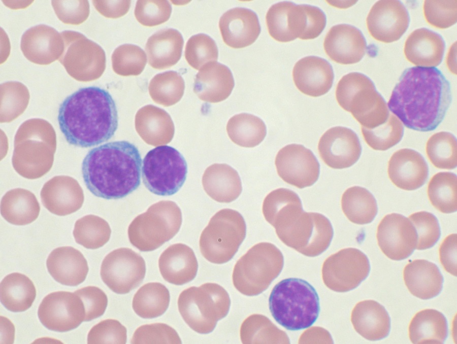 A blood smear with red blood cells and five white blood cells