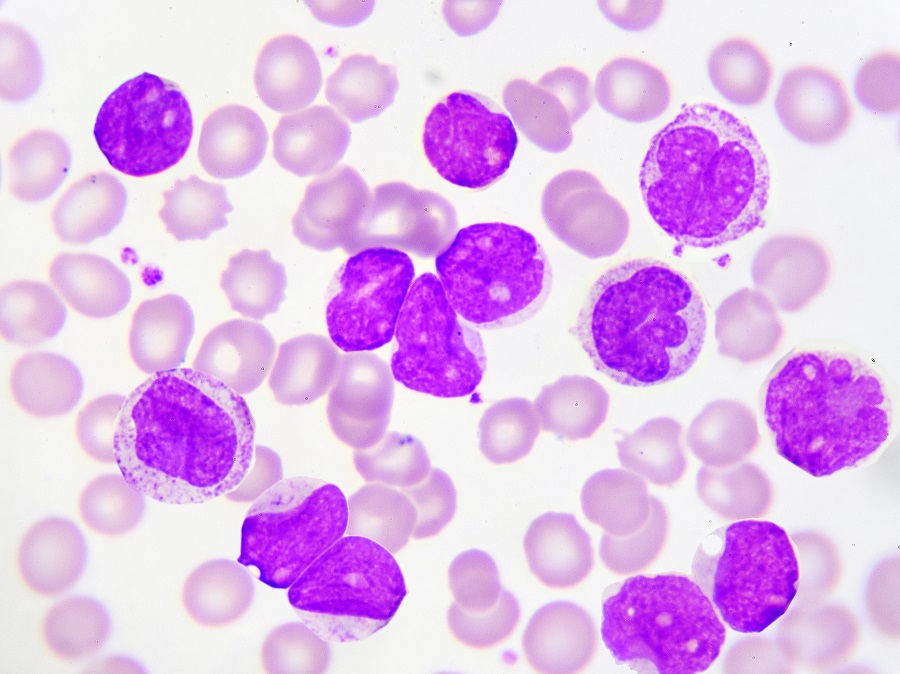 Leukemia cells in peripheral blood smear