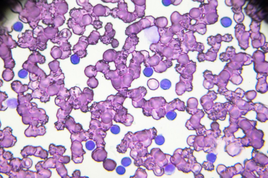 blood smear containing lymphocytes