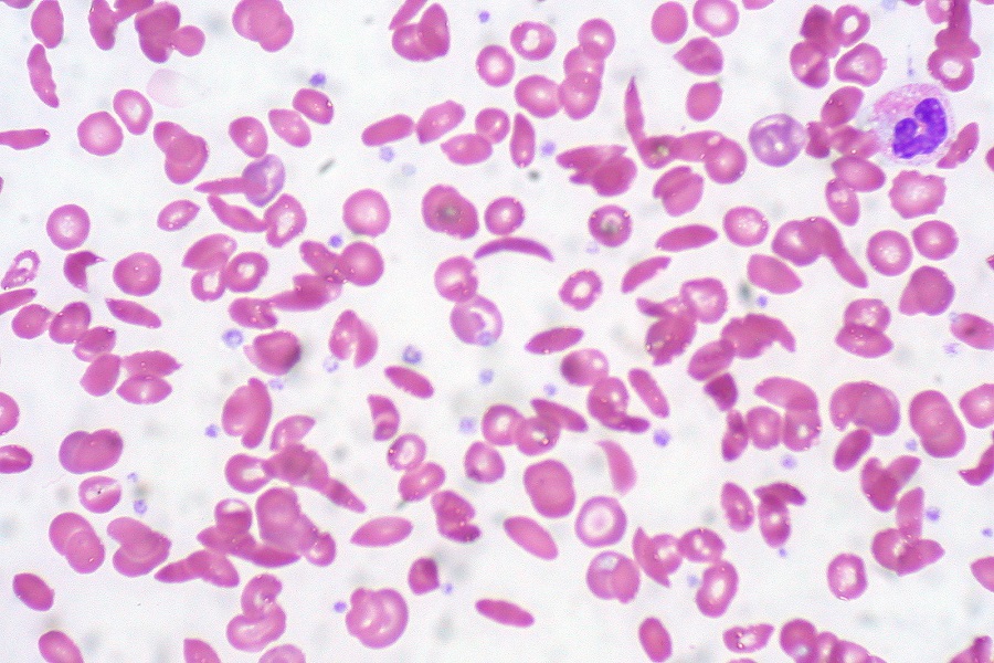 blood smear containing monocyte